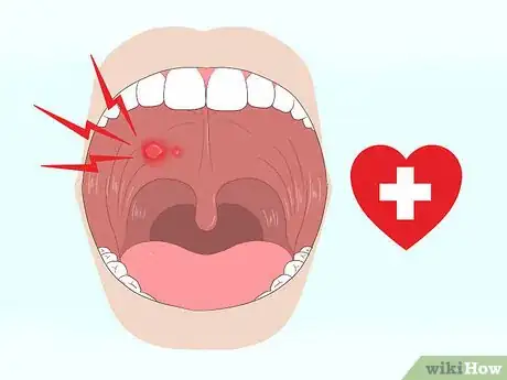 Imagen titulada Get Rid of Mouth Blisters Step 19