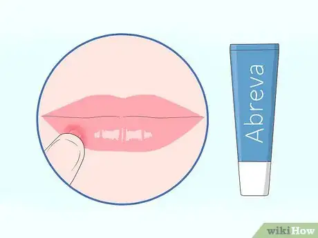 Imagen titulada Get Rid of Mouth Blisters Step 3