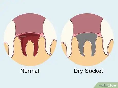 Imagen titulada Prevent Dry Socket After a Tooth Extraction Step 9