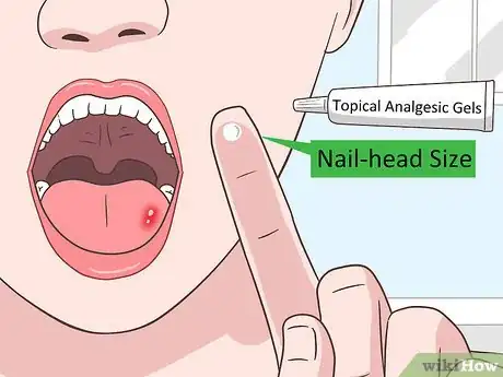 Imagen titulada Heal a Tongue Ulcer Step 4