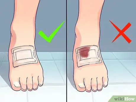 Imagen titulada Change a Wound Dressing Step 7