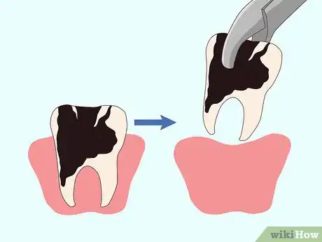 Imagen titulada Cure a Toothache Step 9