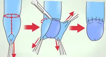 realizar estiramientos para fimosis