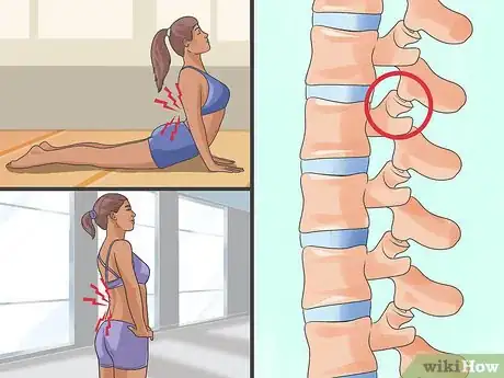 Imagen titulada Determine the Cause of Lower Back Pain Step 8