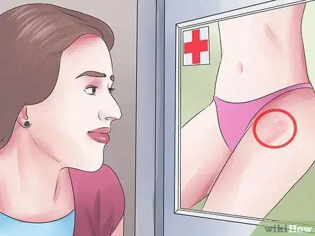 Imagen titulada Test Yourself for HPV Genital Warts Step 1