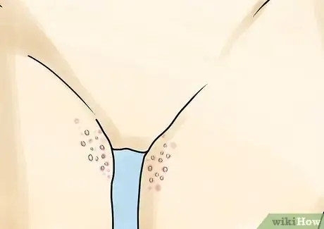 Imagen titulada Know If You Have Herpes Step 8