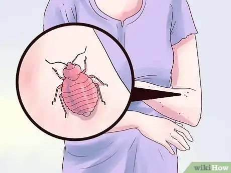 Imagen titulada Treat Bed Bug Bites Step 2