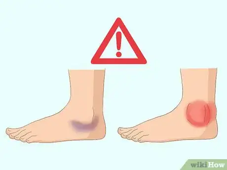 Imagen titulada Wrap an Ankle with an ACE Bandage Step 17