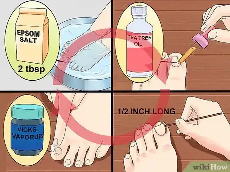 Imagen titulada Heal an Ingrown Toenail Step 5