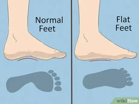 Imagen titulada Fix Flat Feet Step 1