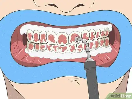 Imagen titulada Fix Nicotine Stained Teeth Step 8