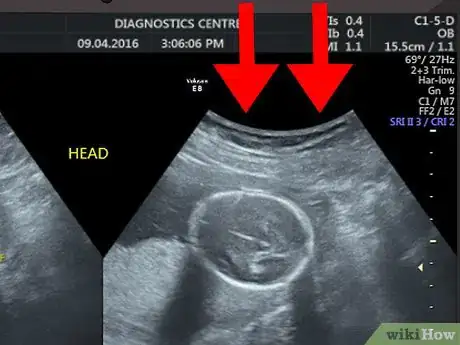 Imagen titulada Read an Ultrasound Picture Step 2