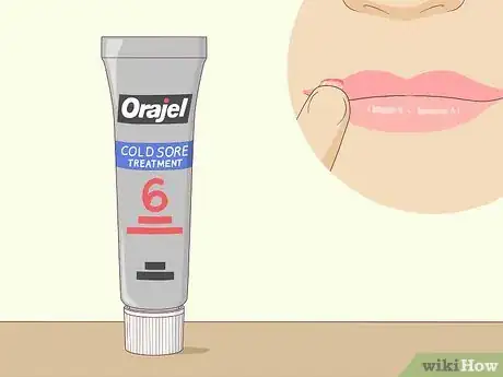 Imagen titulada Get Rid of a Cold Sore Step 1