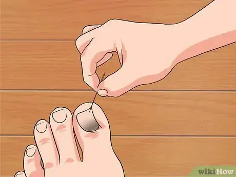 Imagen titulada Remove a Dead Toenail Step 4