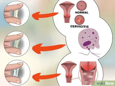 Imagen titulada Diagnose Vaginal Discharge Step 6