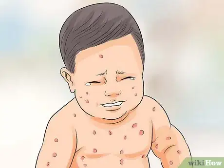 Imagen titulada Spot Meningitis in Babies Step 11