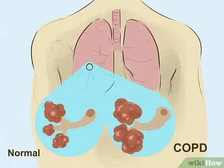 Imagen titulada Diagnose Lung Hyperinflation Step 8