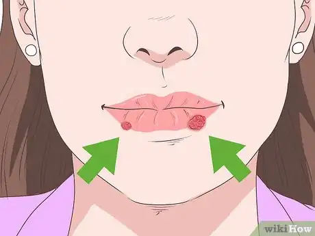 Imagen titulada Treat a Cold Sore or Fever Blisters Step 1