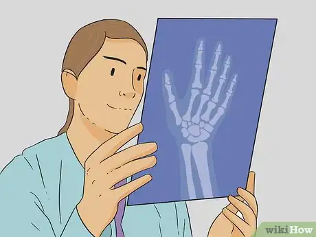 Imagen titulada Diagnose a Broken Thumb Step 11