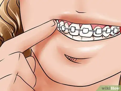 Imagen titulada Apply Dental Wax on Braces Step 4