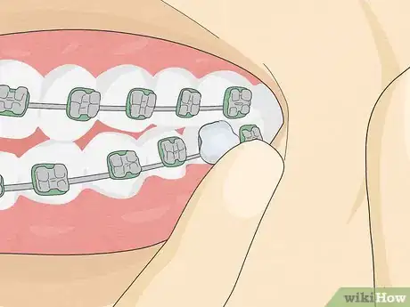 Imagen titulada Temporarily Fix a Loose Wire on Your Braces Step 7