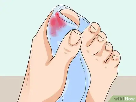 Imagen titulada Treat a Torn Toenail Step 2