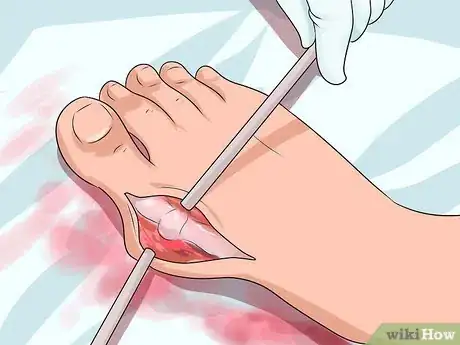 Imagen titulada Get Rid of Bunions Step 11