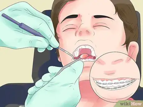 Imagen titulada Alleviate Orthodontic Brace Pain Step 18
