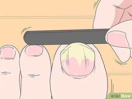 Imagen titulada Trim Toenails with Fungus Step 5