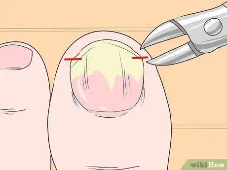 Imagen titulada Trim Toenails with Fungus Step 4