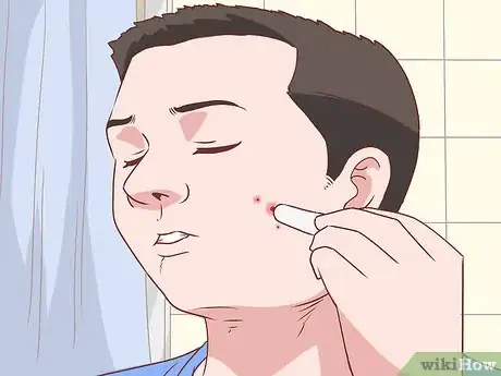 Imagen titulada Stop a Zit from Bleeding Step 4