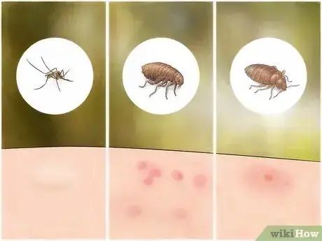 Imagen titulada Identify Insect Bites Step 2