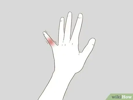 Imagen titulada Determine if a Finger Is Broken Step 3