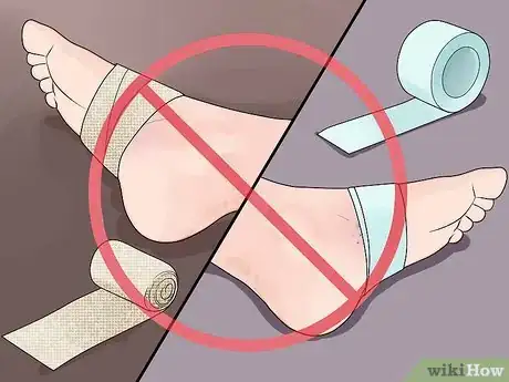 Imagen titulada Treat a Sea Urchin Sting Step 6