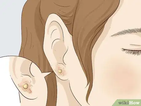 Imagen titulada Keep a Piercing from Rejecting Step 5.jpeg