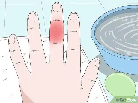 Imagen titulada Cure an Infected Finger Step 1