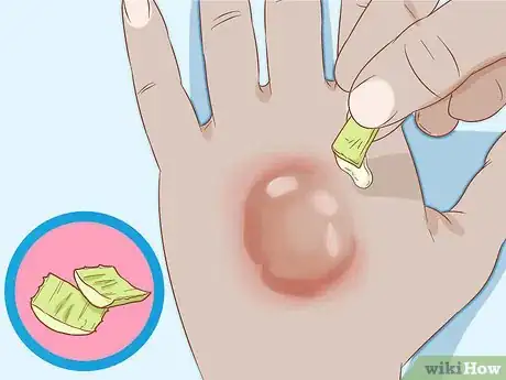 Imagen titulada Get Rid of Poison Ivy Rashes Step 13