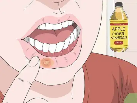 Imagen titulada Treat Mouth Ulcers Naturally Step 5