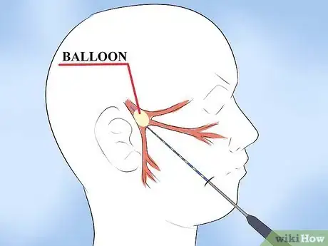 Imagen titulada Alleviate Pain Caused by Trigeminal Neuralgia Step 8
