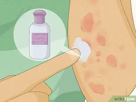 Imagen titulada Recognize Hives (Rash) Step 11