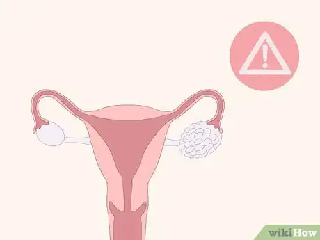 Imagen titulada Identify Abnormal Vaginal Spotting Between Periods Step 6