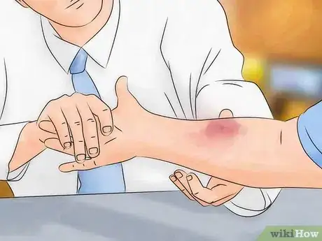 Imagen titulada Identify and Treat Recluse (Fiddleback) Spider Bites Step 4