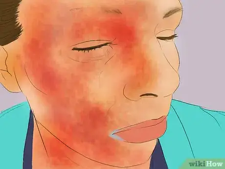 Imagen titulada Treat Pimples with Fucidin Step 7
