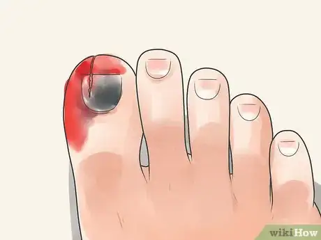 Imagen titulada Treat a Stubbed Toe Step 1