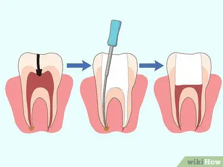 Imagen titulada Cure a Toothache Step 8