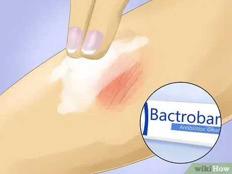 Imagen titulada Relieve Blister Pain Step 5