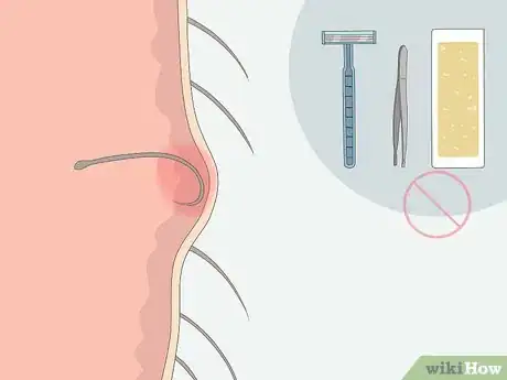 Imagen titulada Get Rid of Ingrown Pubic Hair Step 1