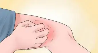 saber la diferencia entre el eccema y la psoriasis