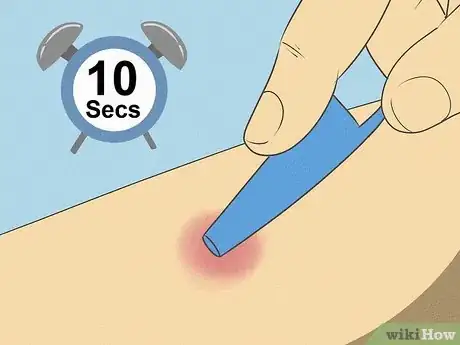 Imagen titulada Get Rid of a Mosquito Bite Step 10