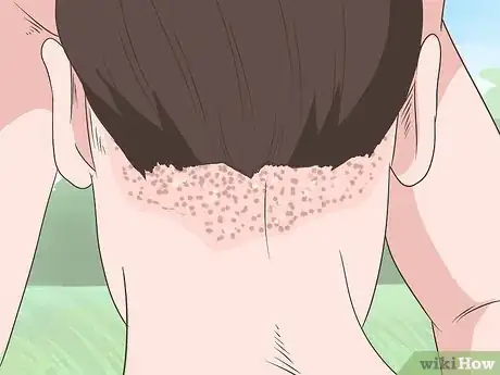 Imagen titulada Heal Scalp Eczema Step 1